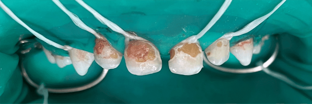 Comprehensive treatment of primary teeth under general anesthesia