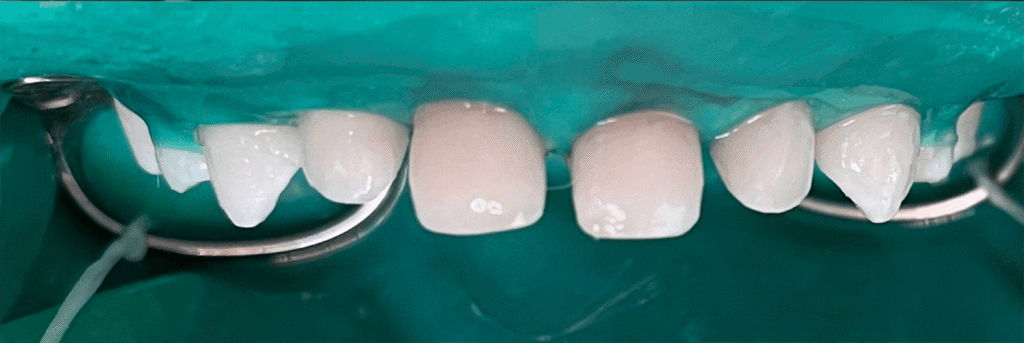 Comprehensive treatment of primary teeth under general anesthesia
