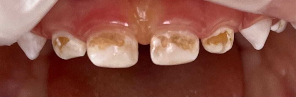 Comprehensive treatment of primary teeth under general anesthesia
