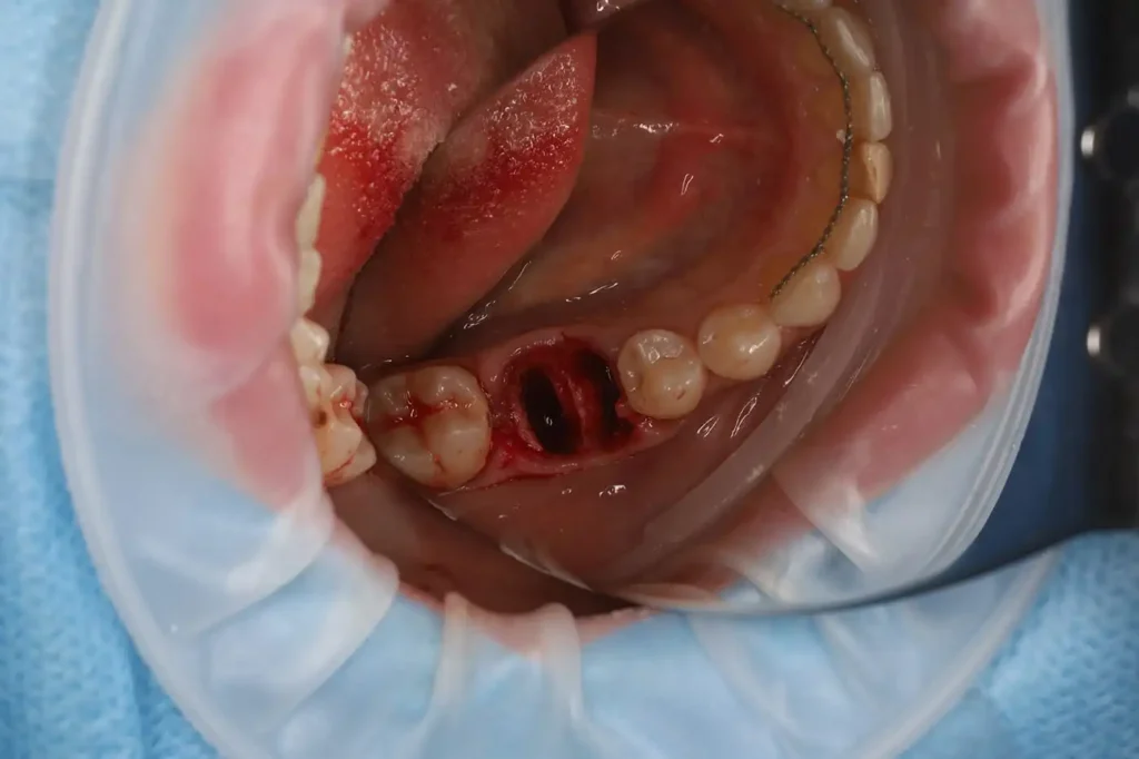 Implant Restoration of a Posterior Tooth with Soft Tissue Augmentation