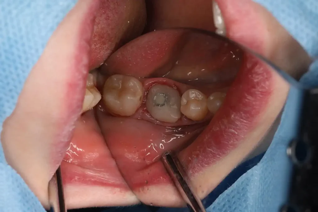 Implant Restoration of a Posterior Tooth with Soft Tissue Augmentation