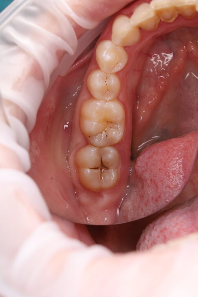 Removal of carious tissues and restoration of the contact surface between teeth 46 and 47, as well as composite restoration of the cervical area of tooth 47.