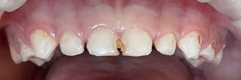 Comprehensive treatment of primary teeth under general anesthesia
