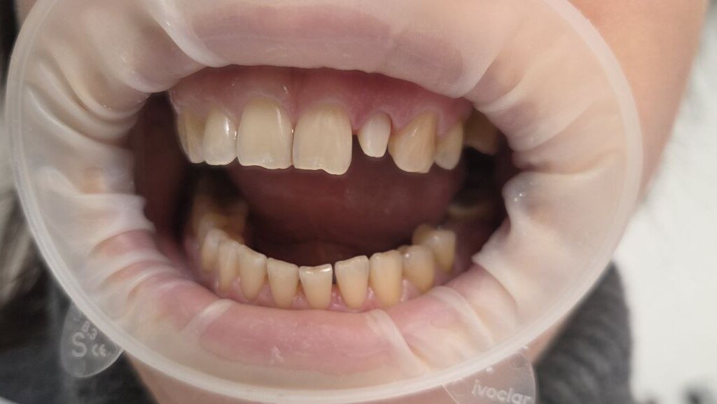 Restoration of Tooth 22 with a Zirconia Post-and-Core and Zirconia Crown