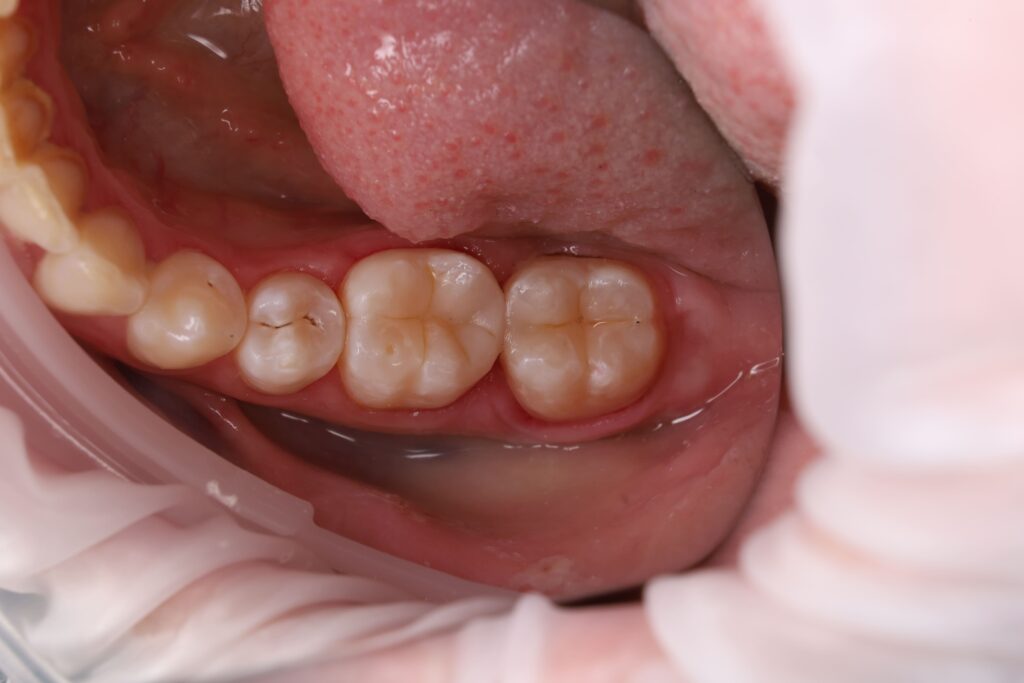 Removal of carious tissues and restoration of the contact surface between teeth 46 and 47, as well as composite restoration of the cervical area of tooth 47.