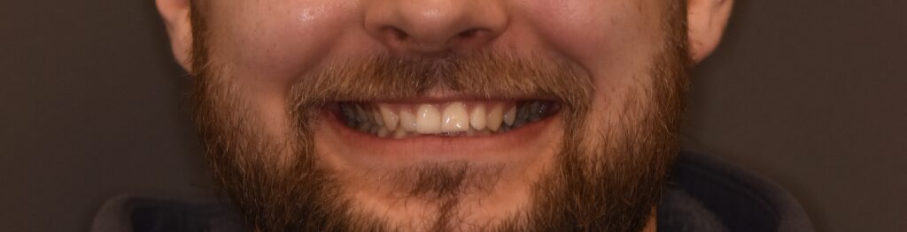 Restoration of Anterior Teeth Aesthetics Using Ceramic Veneers