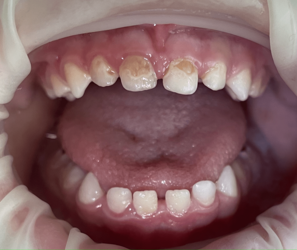 Prosthesis