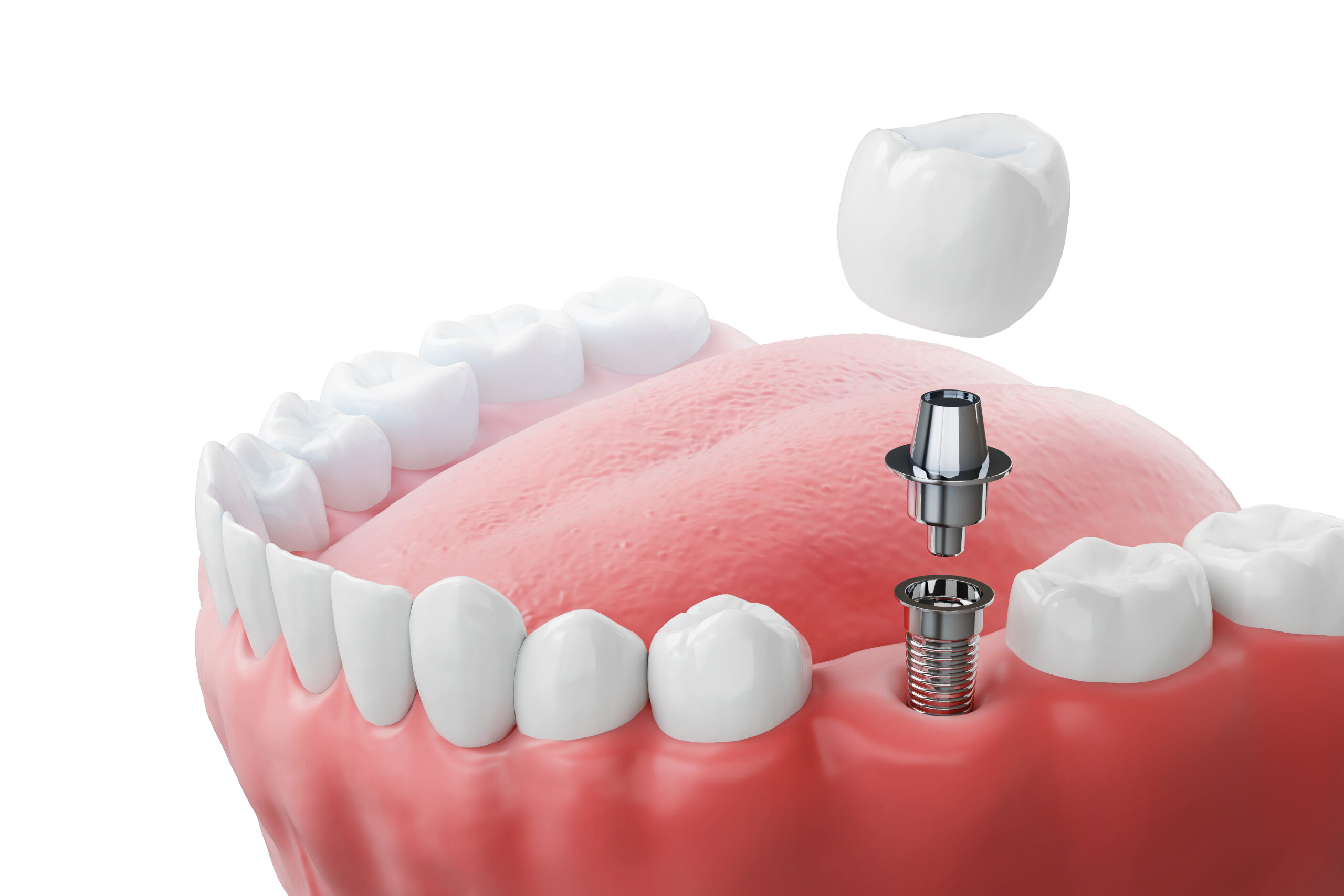 Immediate Dental Implants in Krakow