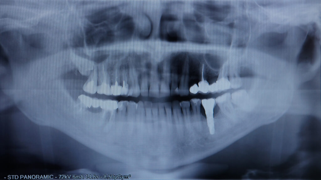 Dental Implants in Krakow