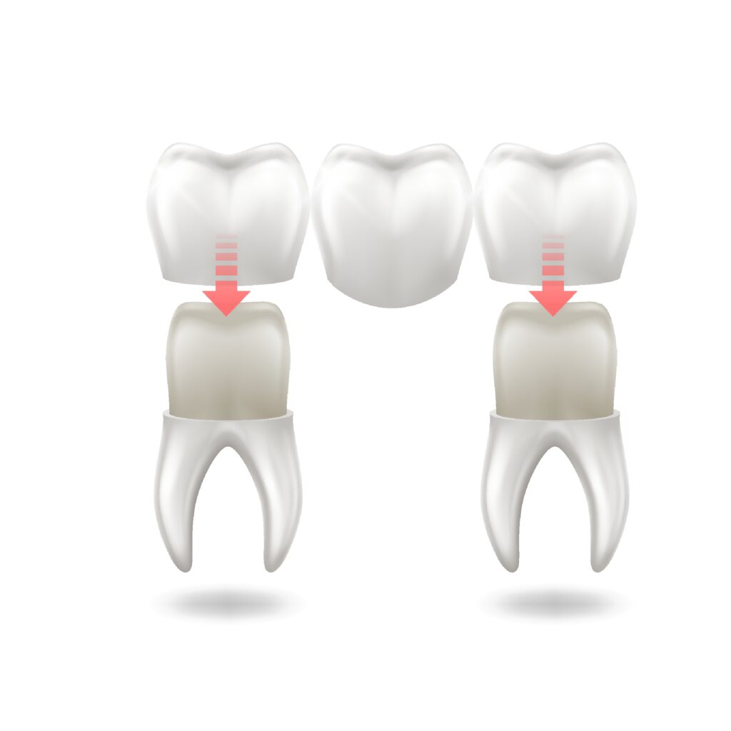 Dental Crowns in Krakow