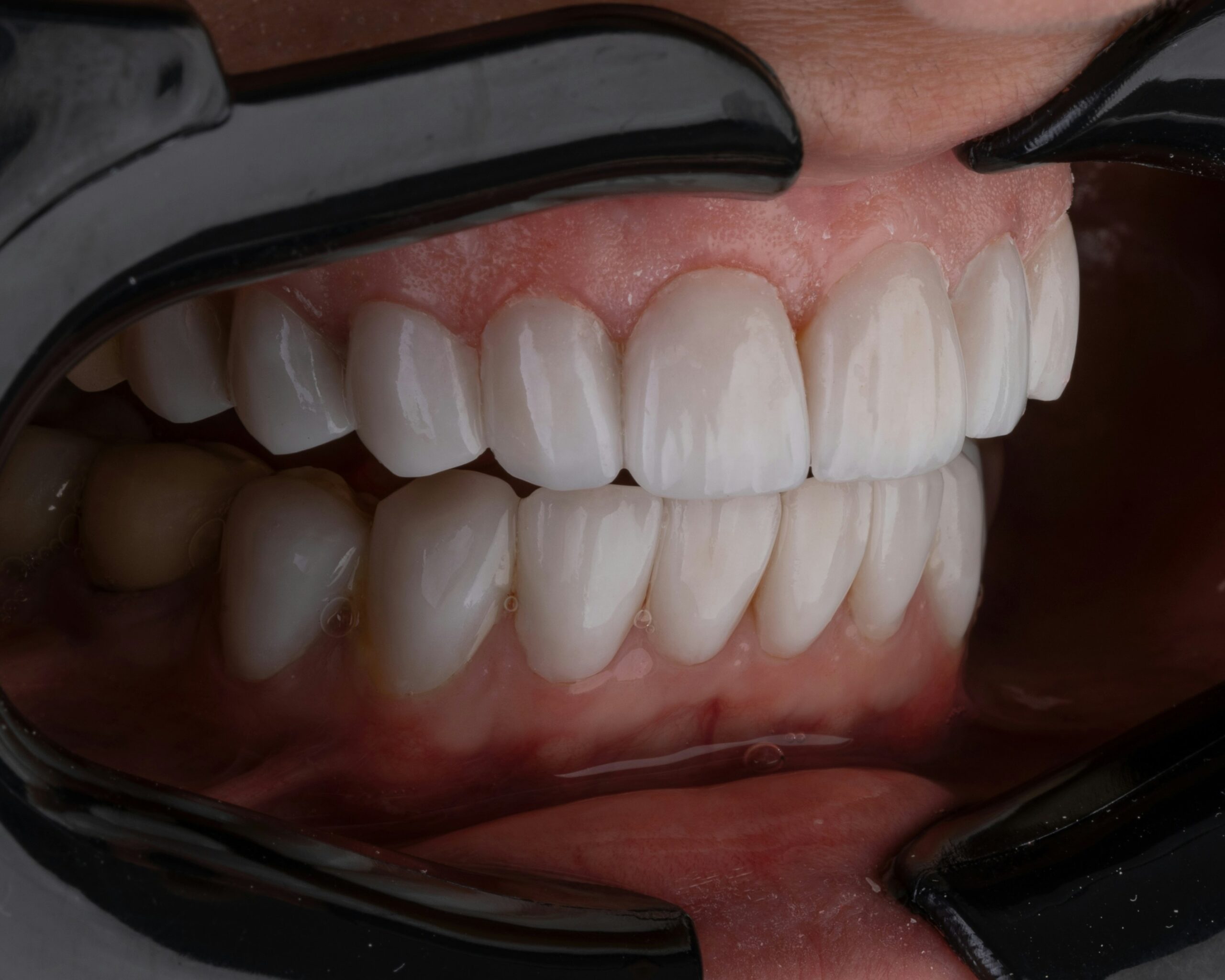 Veneers in Krakow