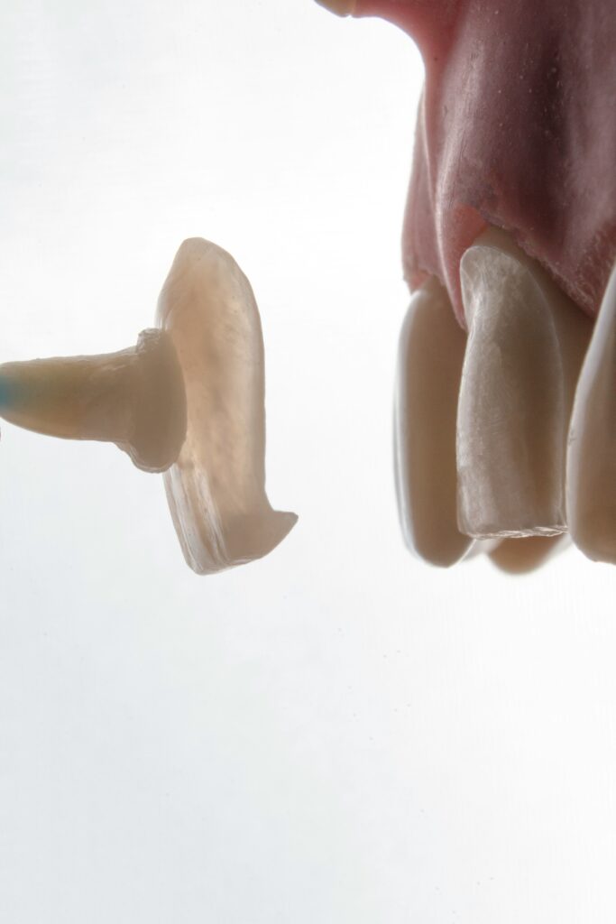 Veneers in Krakow