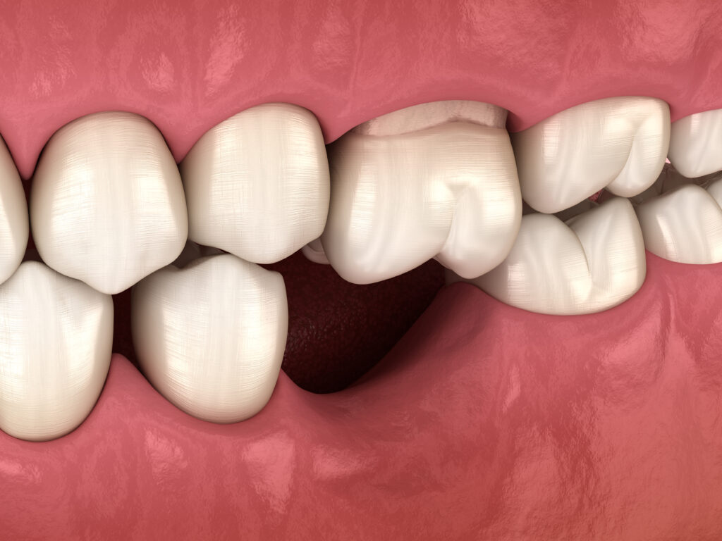 Tooth dislocation treatment