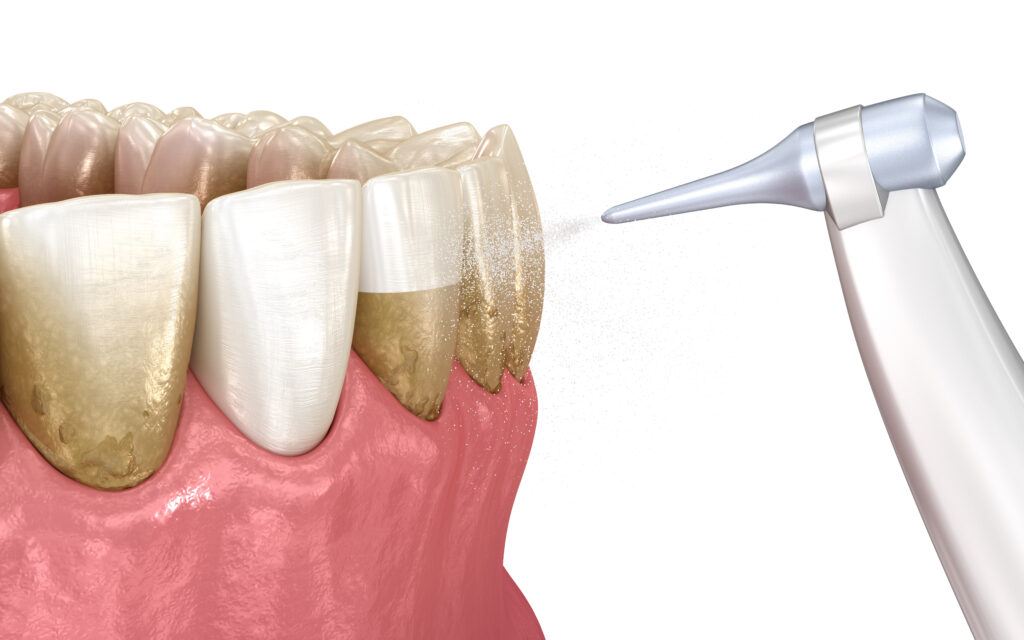 Air Flow Teeth Cleaning
