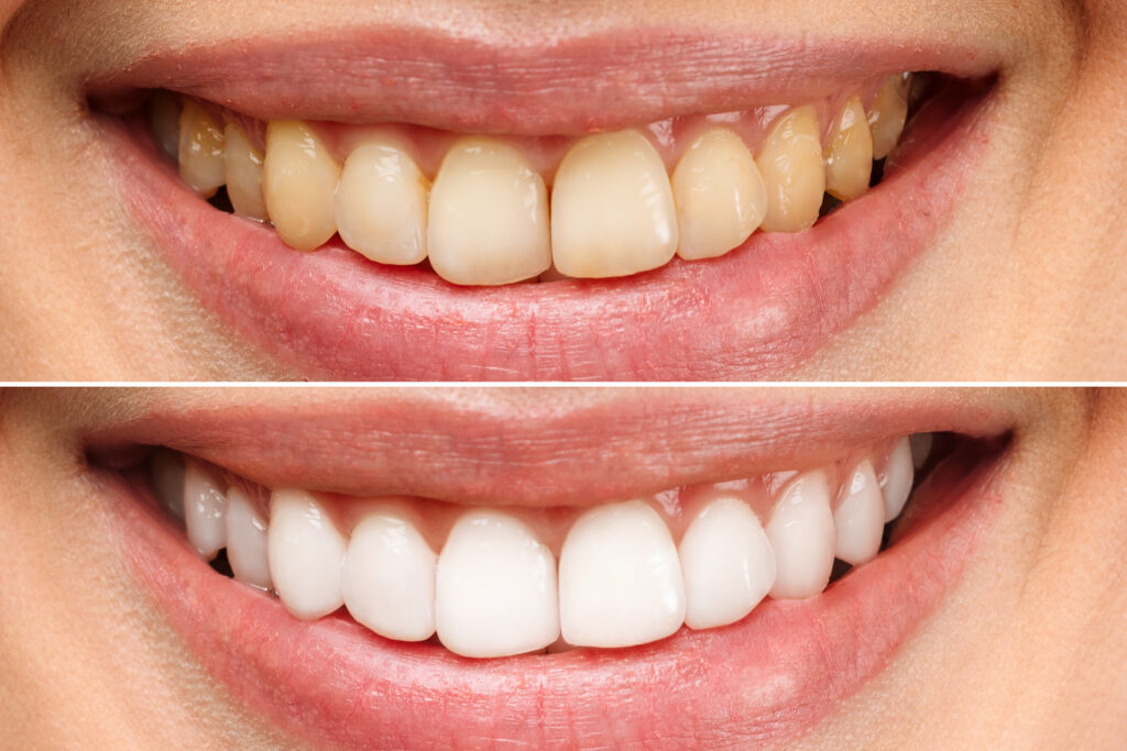 Beyond Lamp Teeth Whitening in Krakow