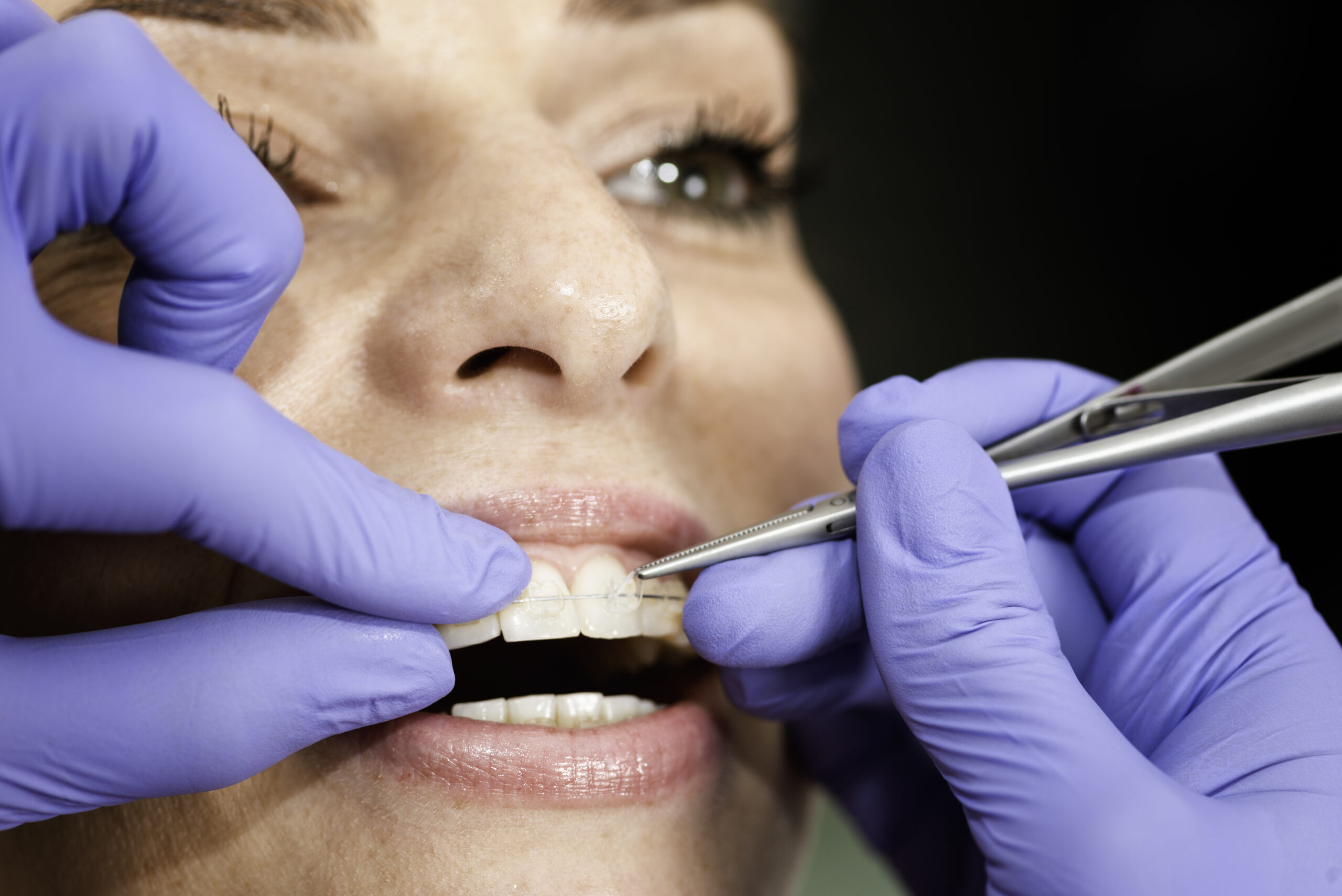 Ceramic braces