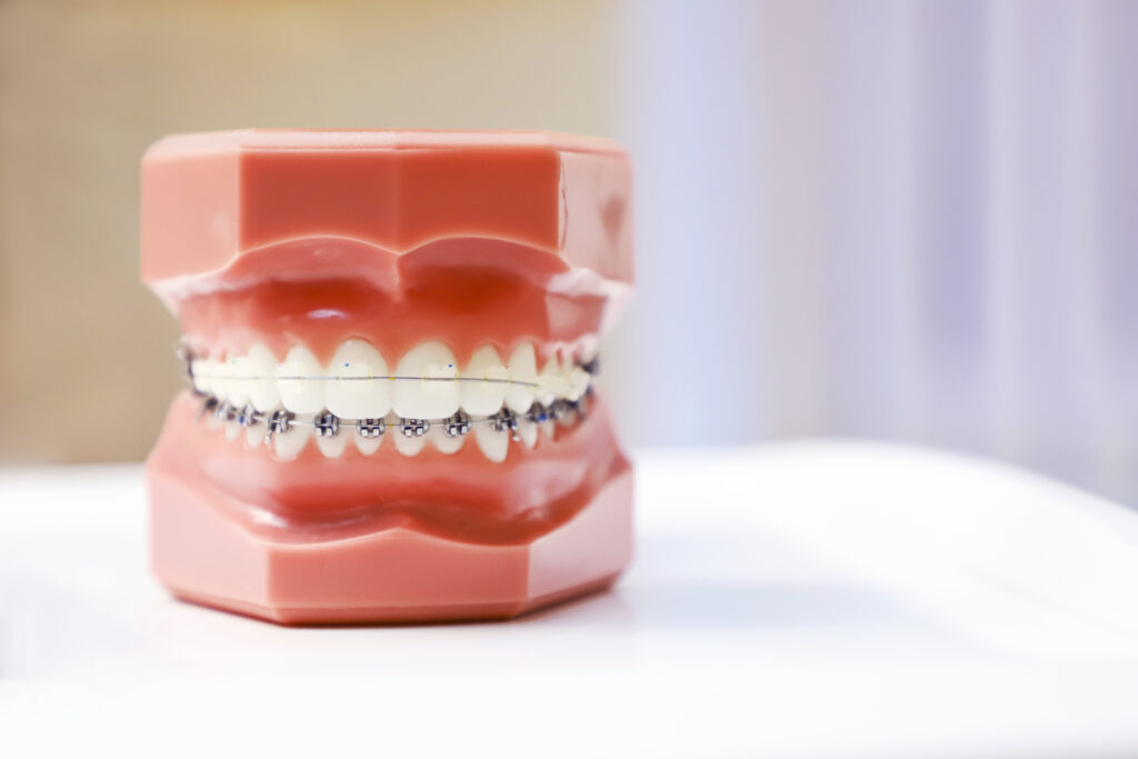 Ceramic braces