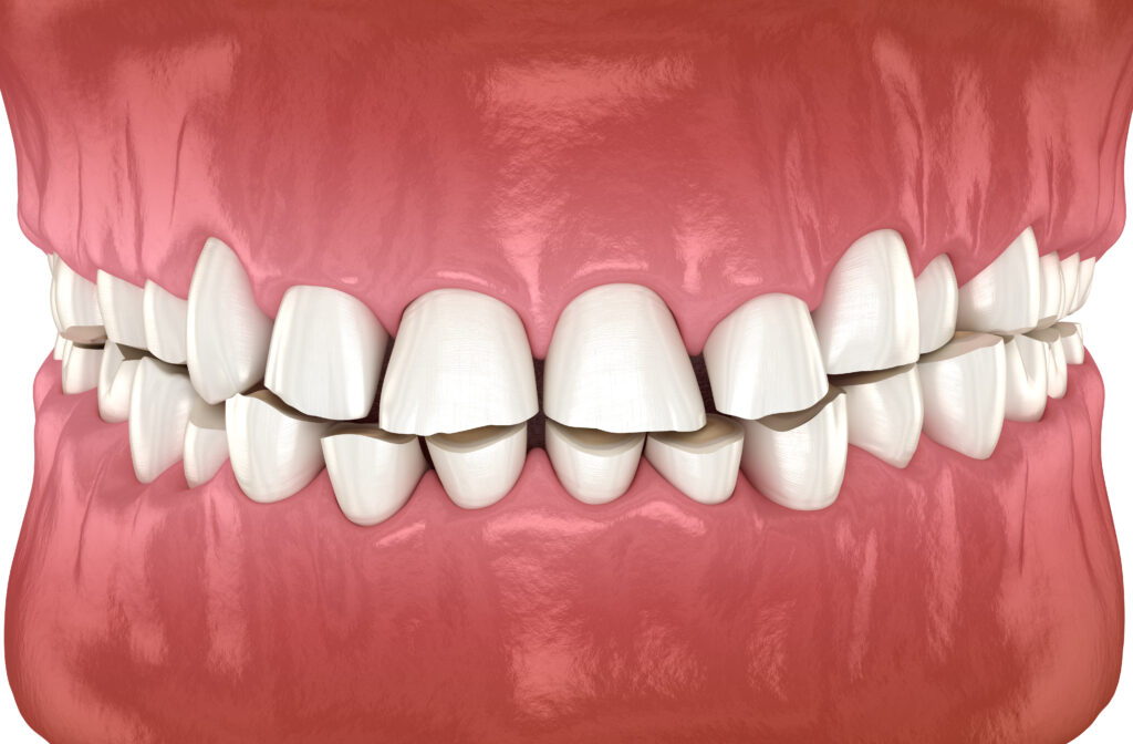 Bruxism Treatment in Krakow