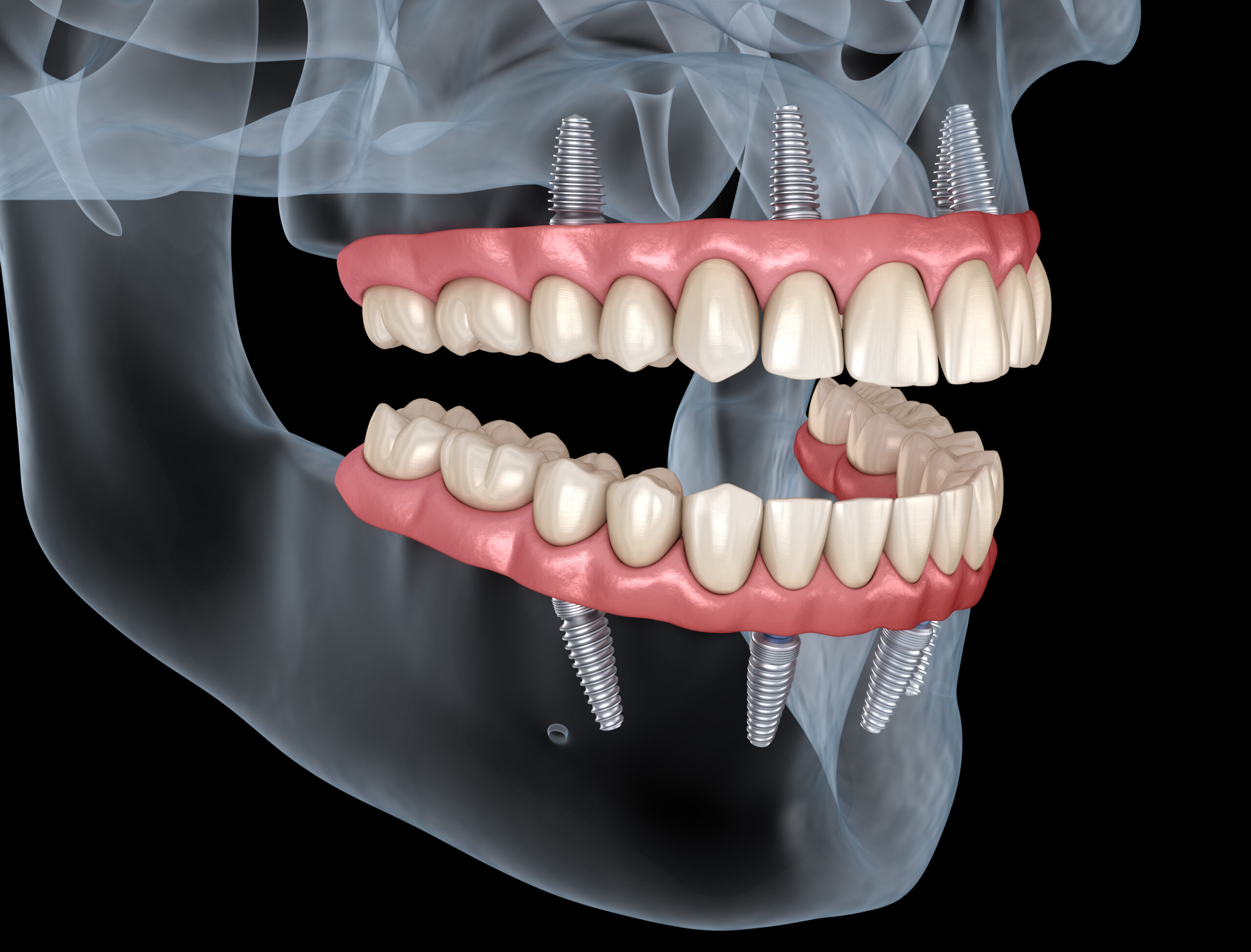 Implantation in case of complete absence of teeth (edentia)