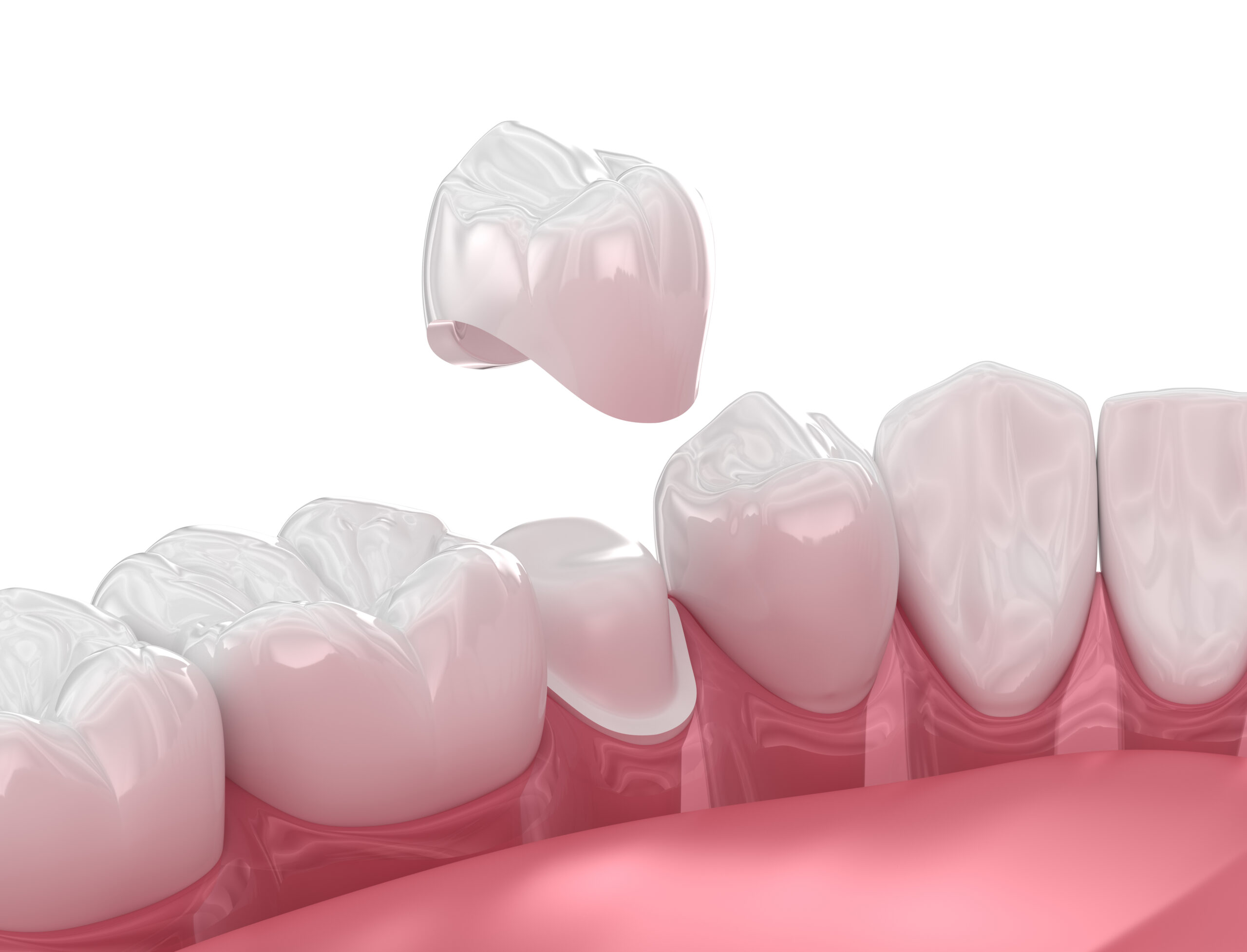 Ceramic crowns using CAD/CAM technology