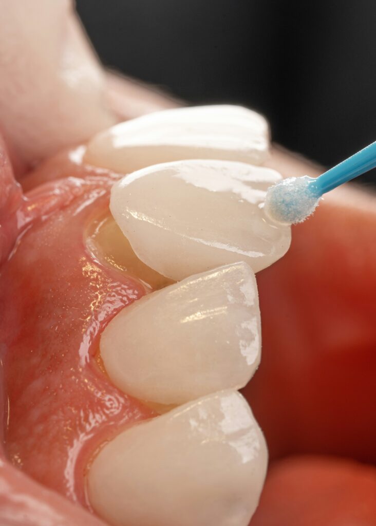 Ceramic veneers CAD/CAM