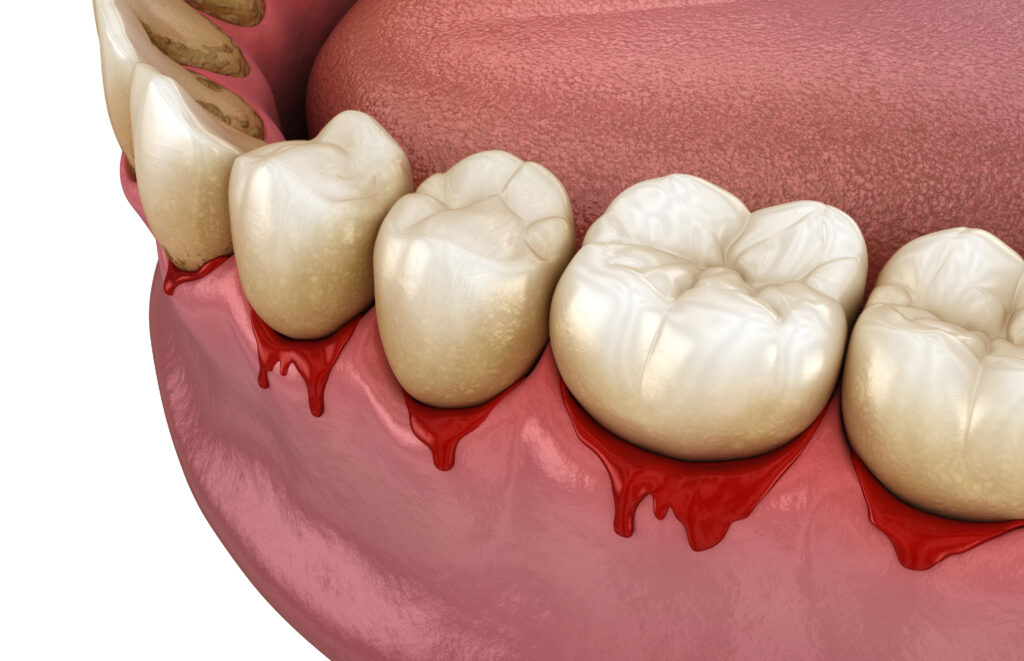 Treatment for Bleeding Gums
