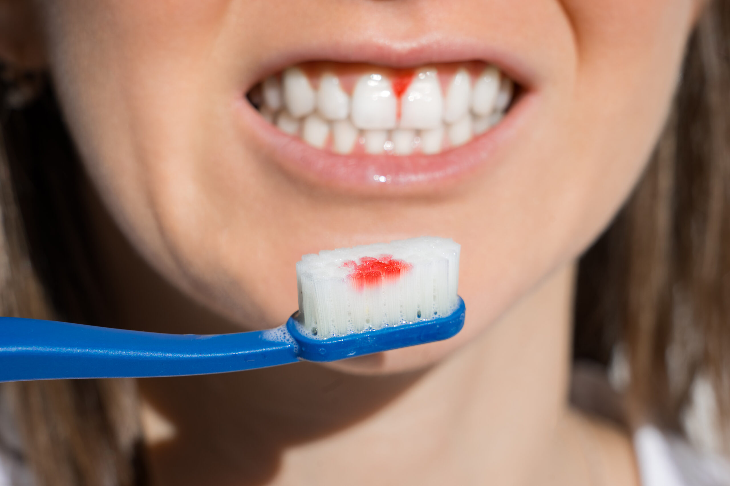 Treatment for Bleeding Gums