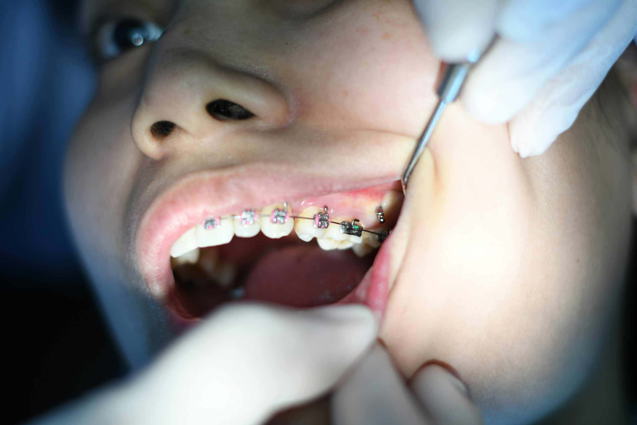 Metal braces