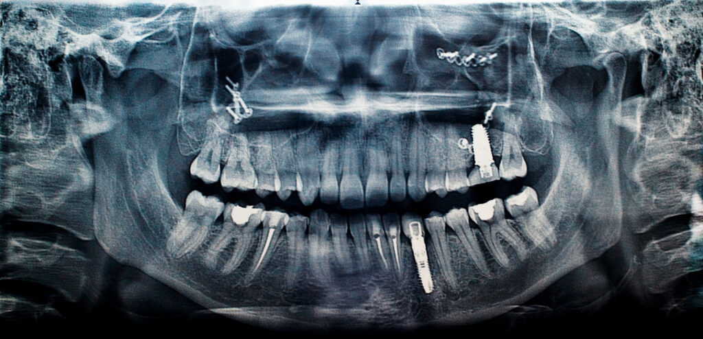 Teeth in a Day in Krakow