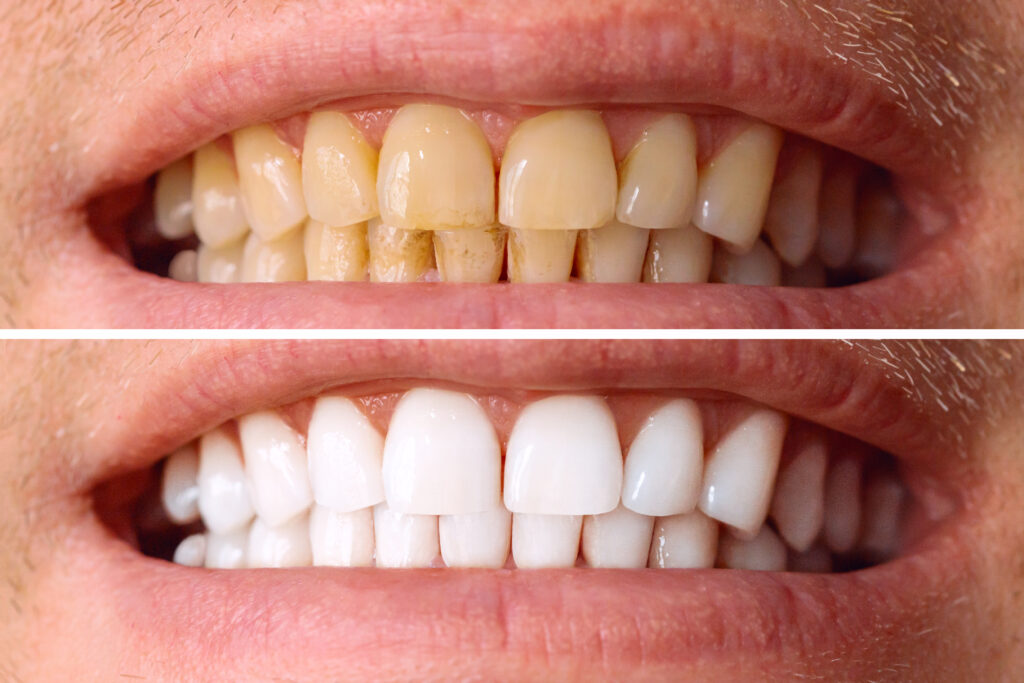 Opalescence teeth whitening