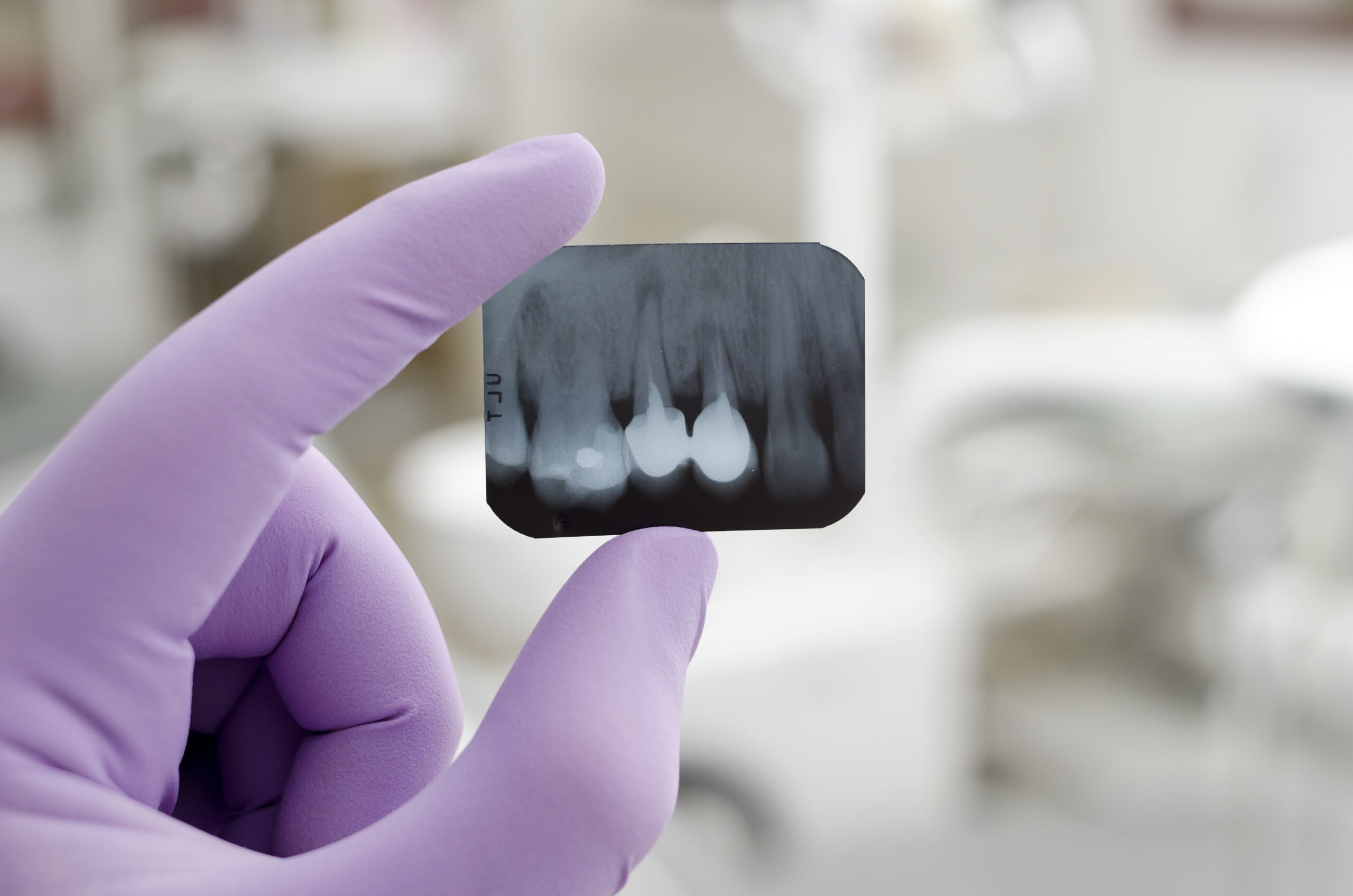 Single tooth X-ray