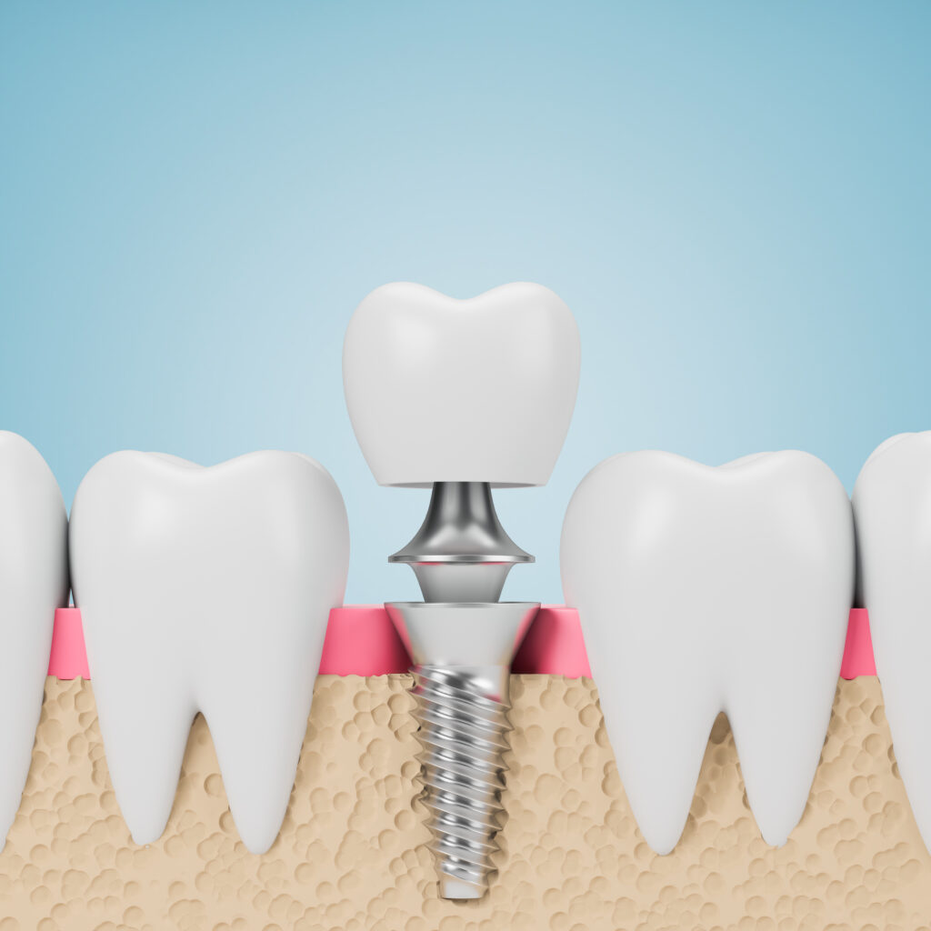 Implant-Supported Dentures in Krakow