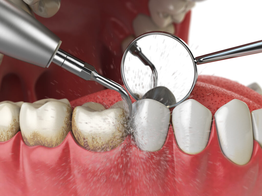 Removal of tartar