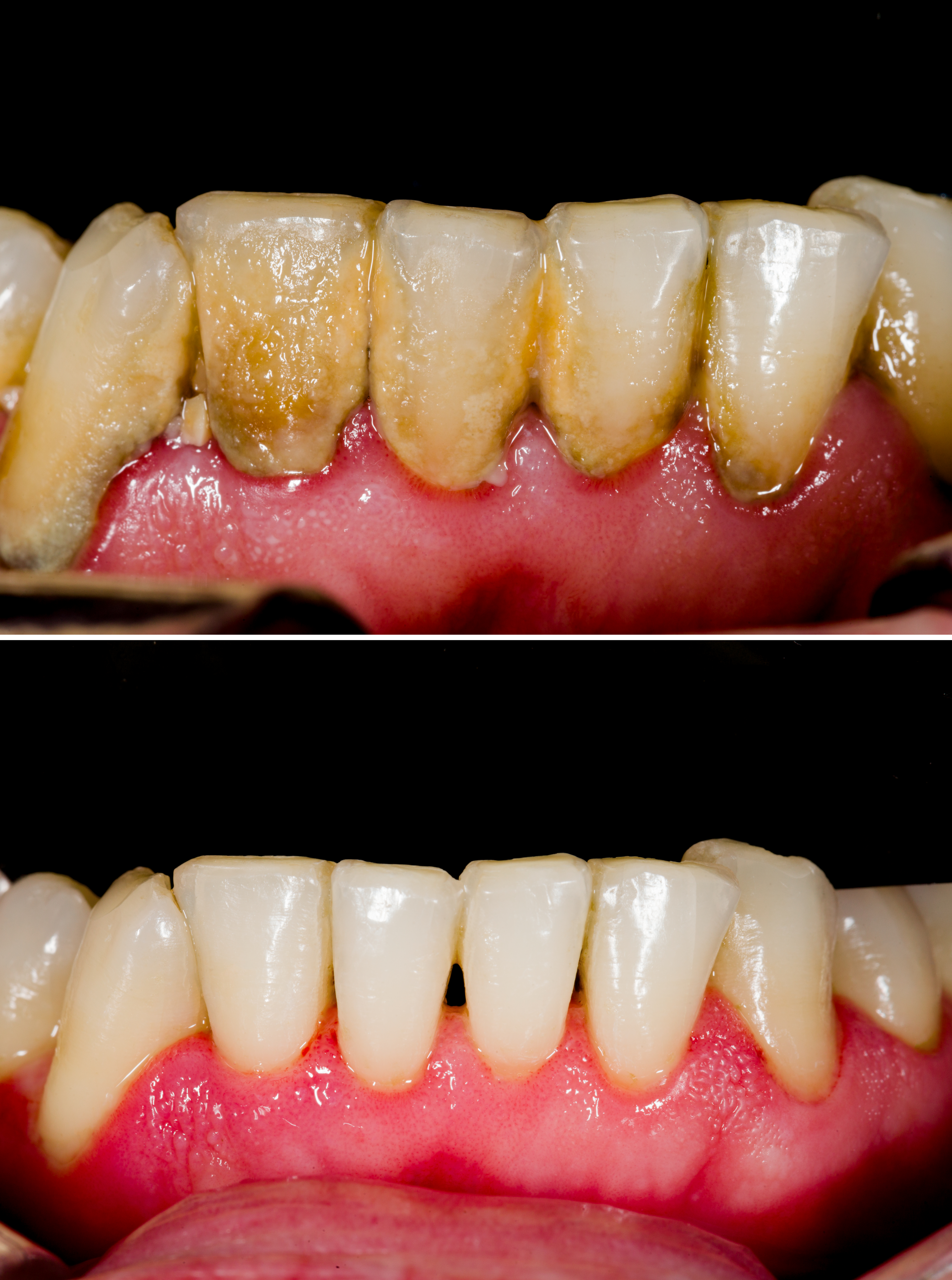 Removal of tartar
