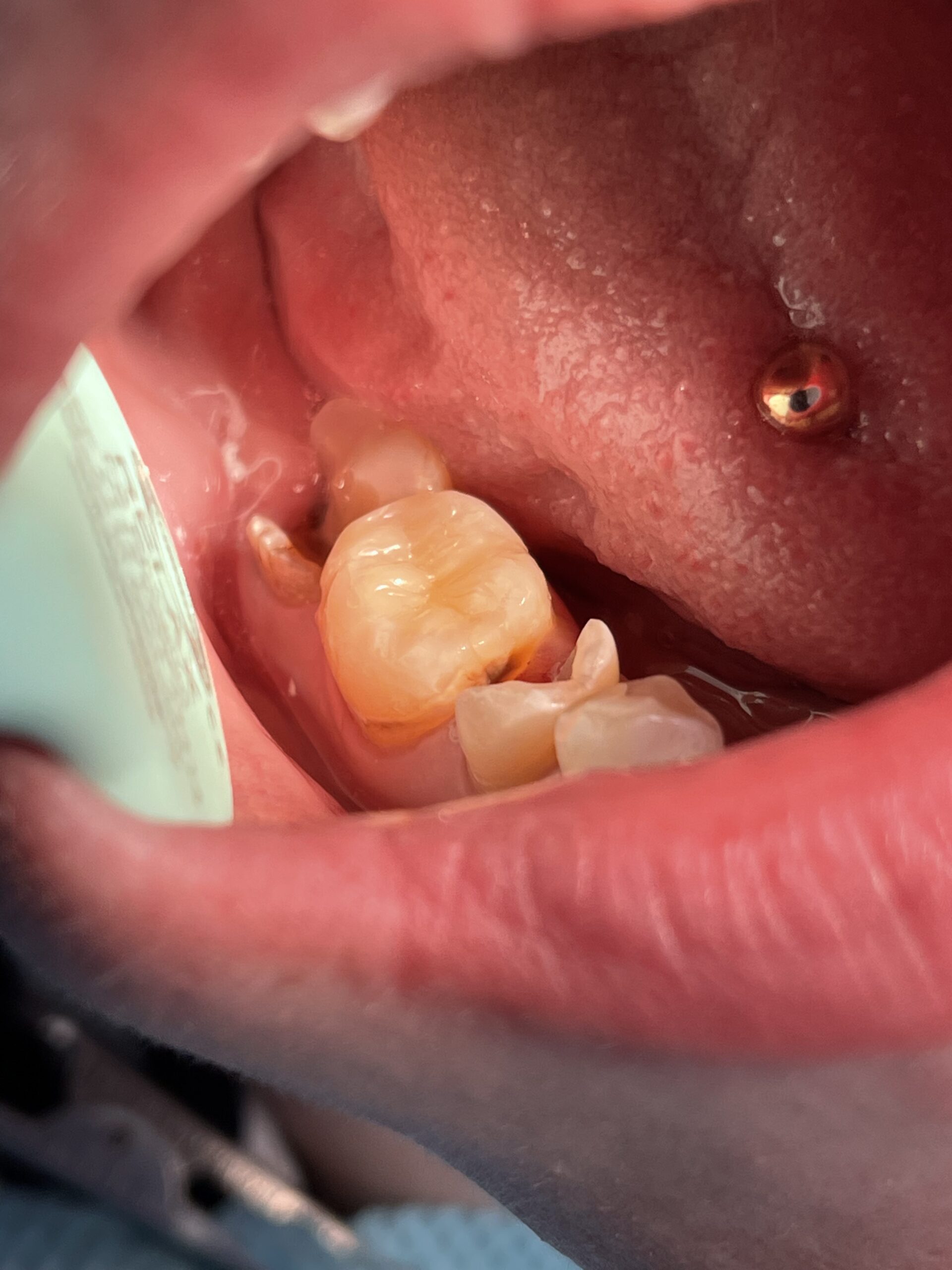 Anti-stress dentistry