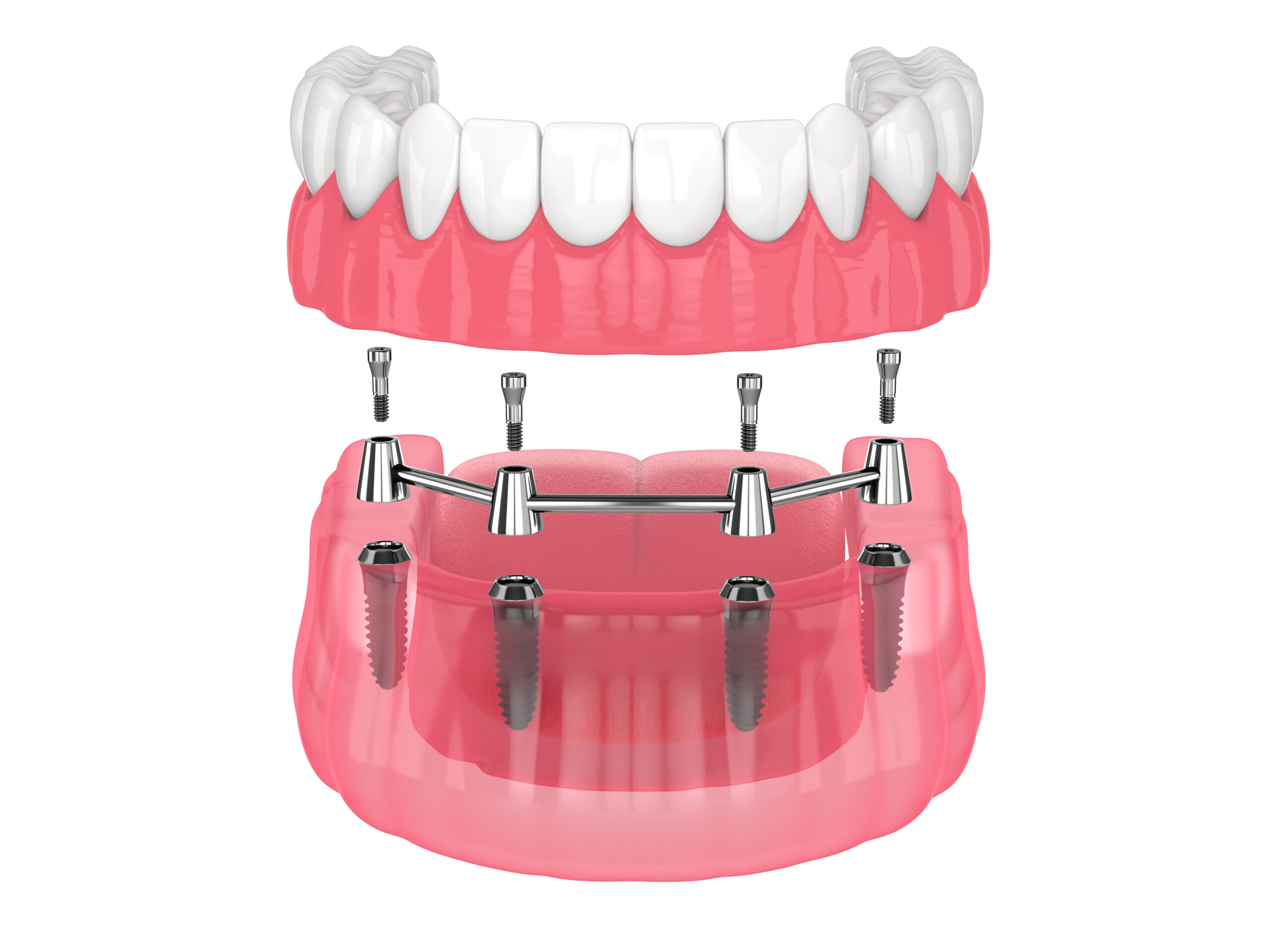 All-on-4 – Metoda proteza na 4 implantach