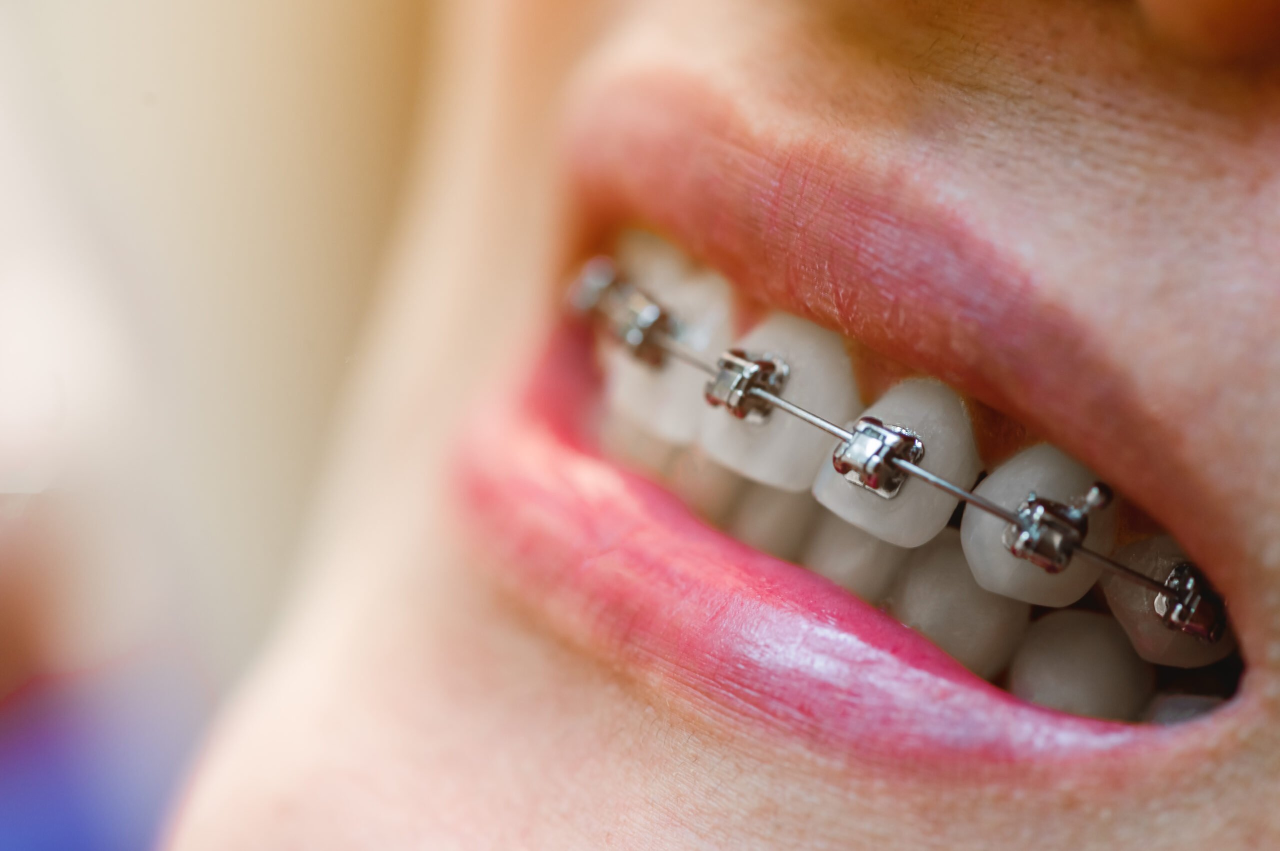 Self-ligating braces 