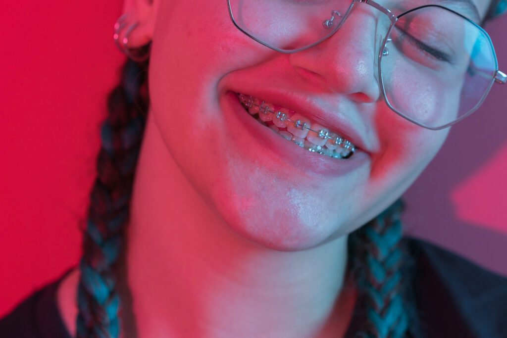 Self-ligating braces 