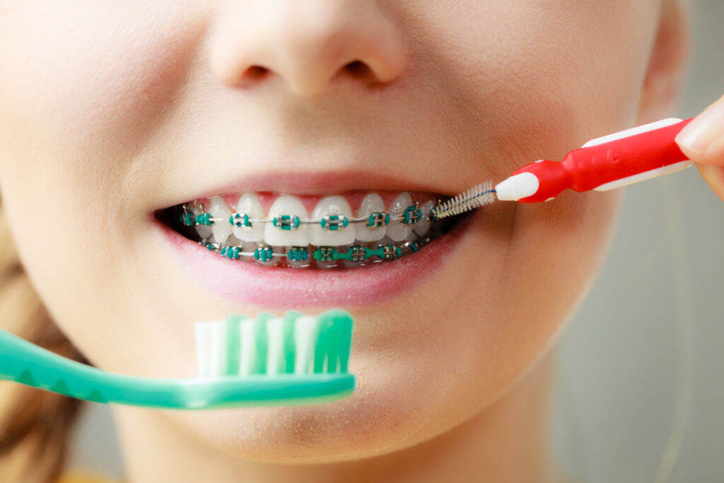 Professional hygiene for braces
