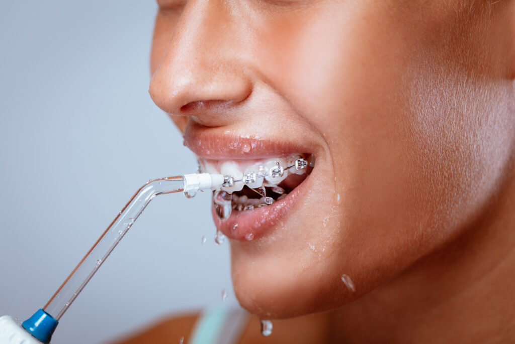 Professional hygiene for braces