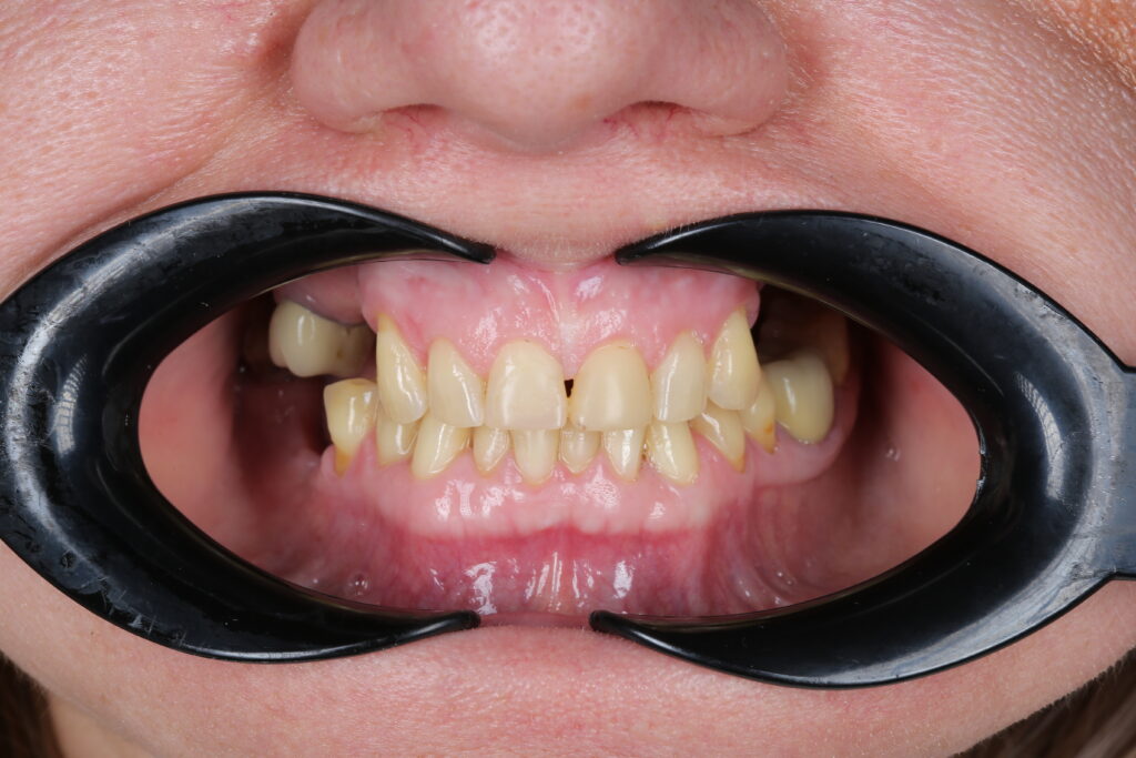 Full dental arch restoration with implantation and prosthetic rehabilitation