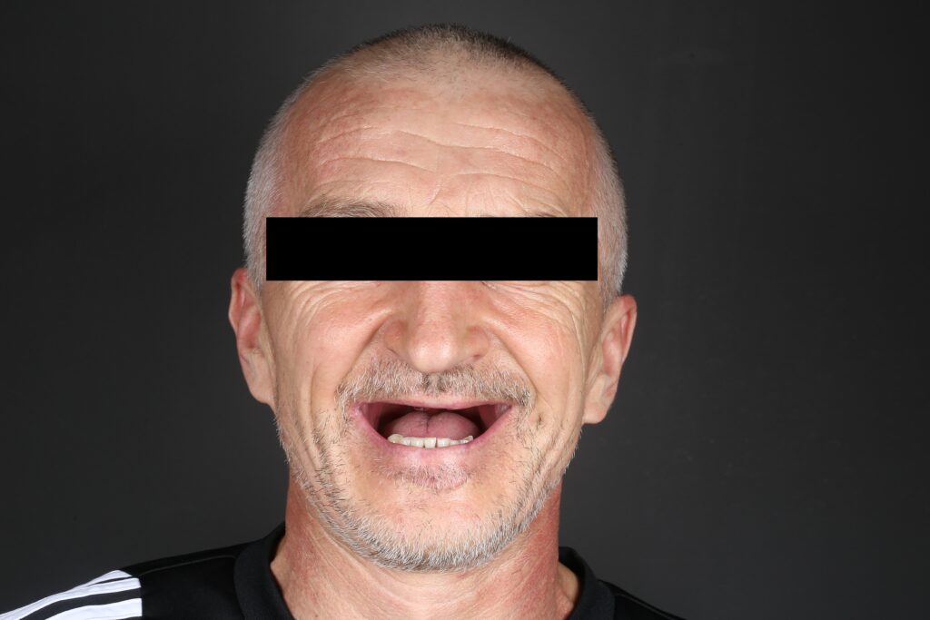 Full upper jaw restoration using the All-on-4 protocol