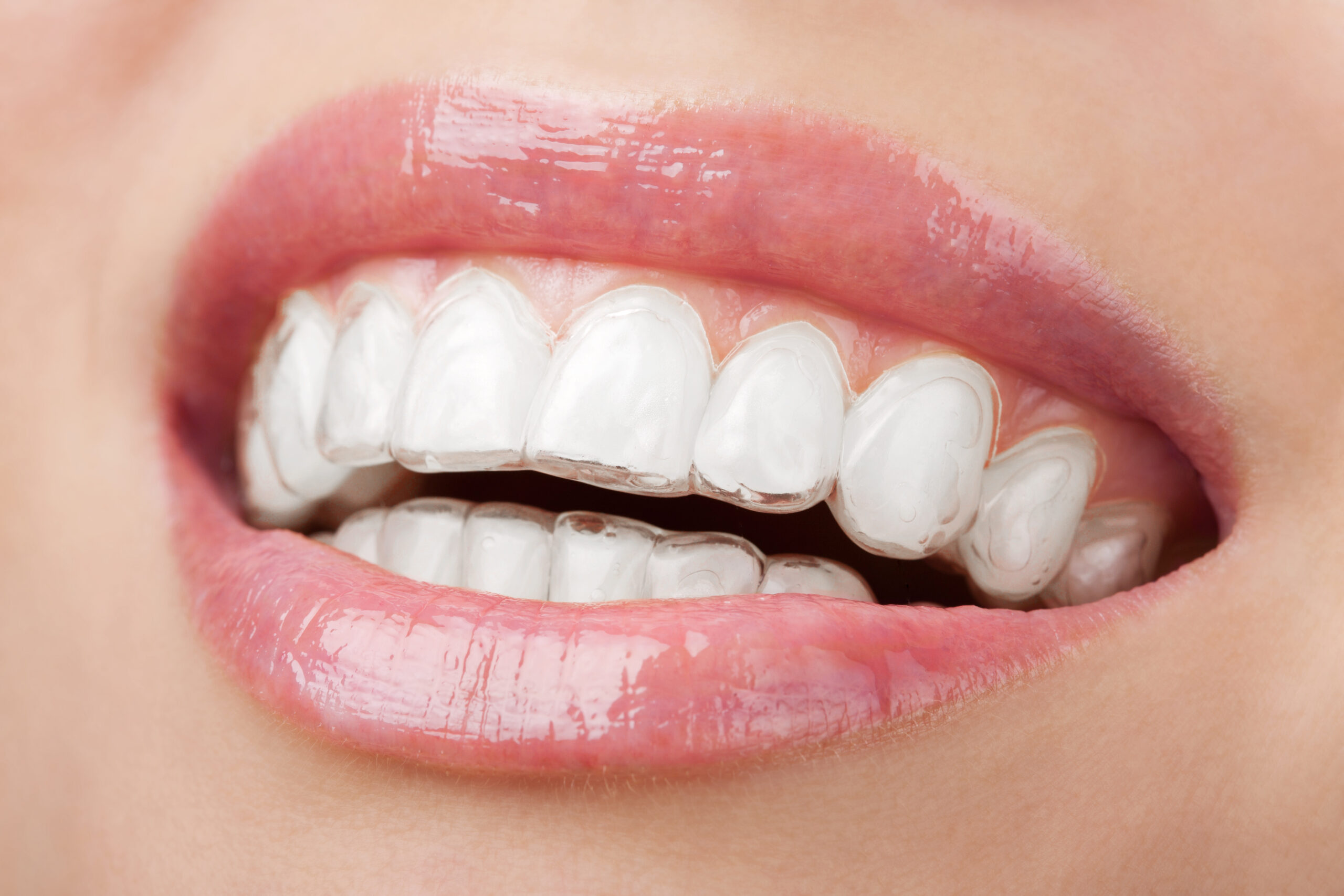 Aligners