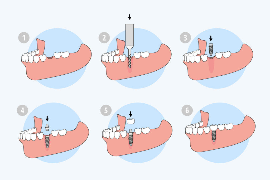 Implants Straumann 