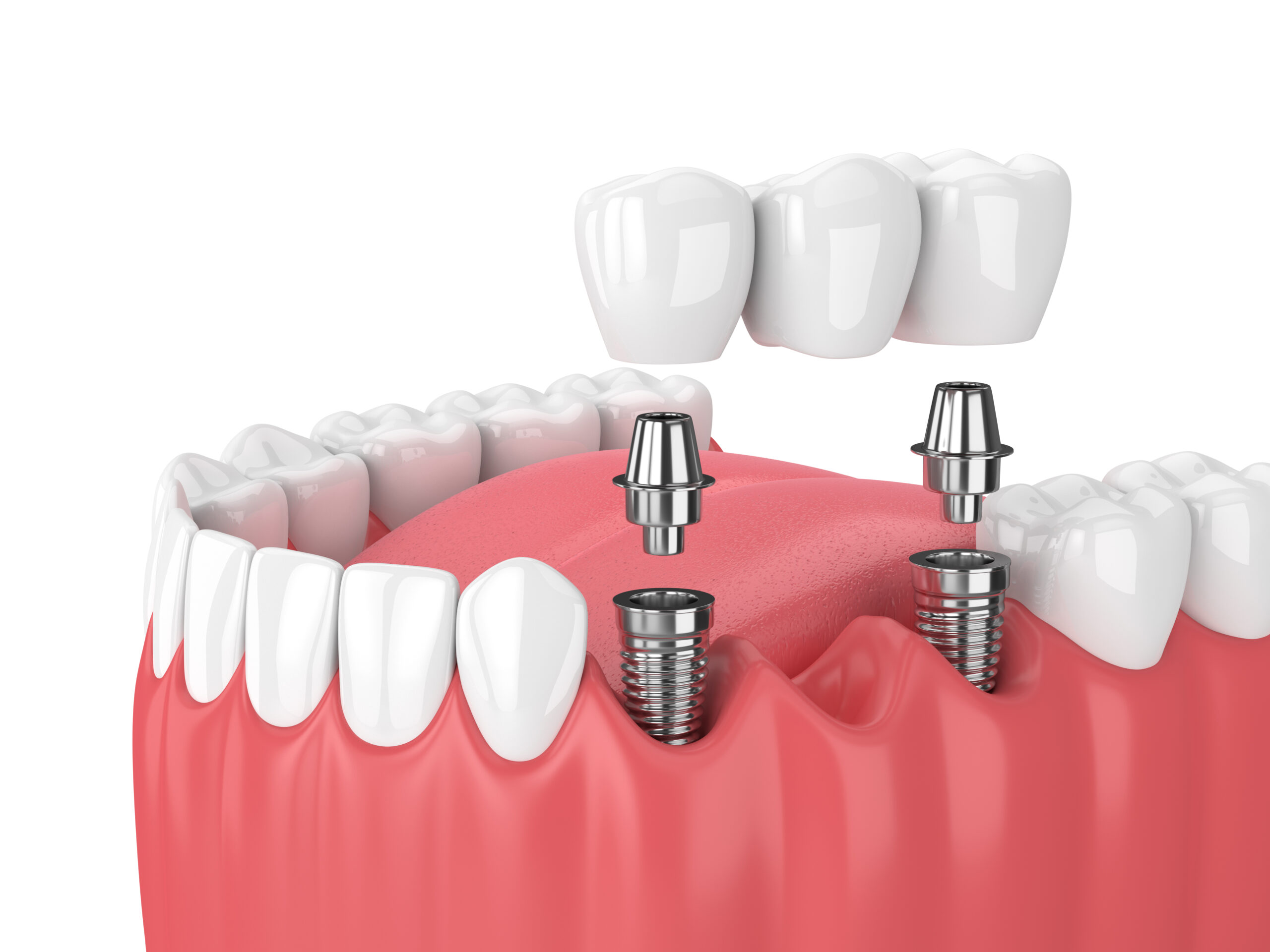 Implants Straumann 