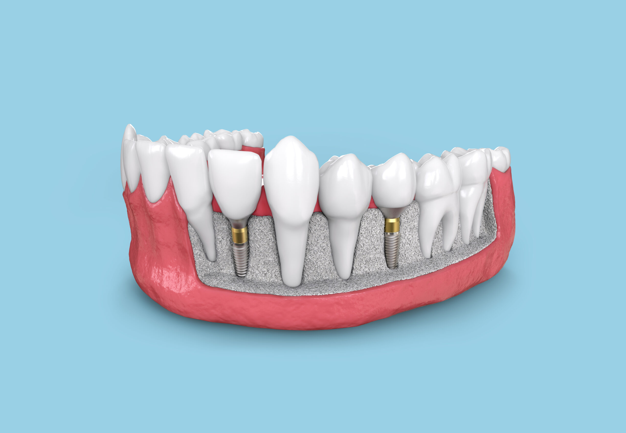 Megagen implants