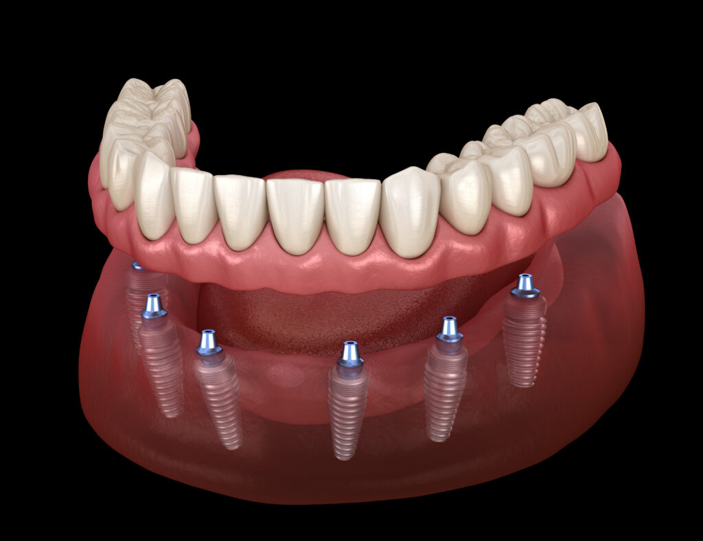 All-on-6 – denture on 6 implants Krakow