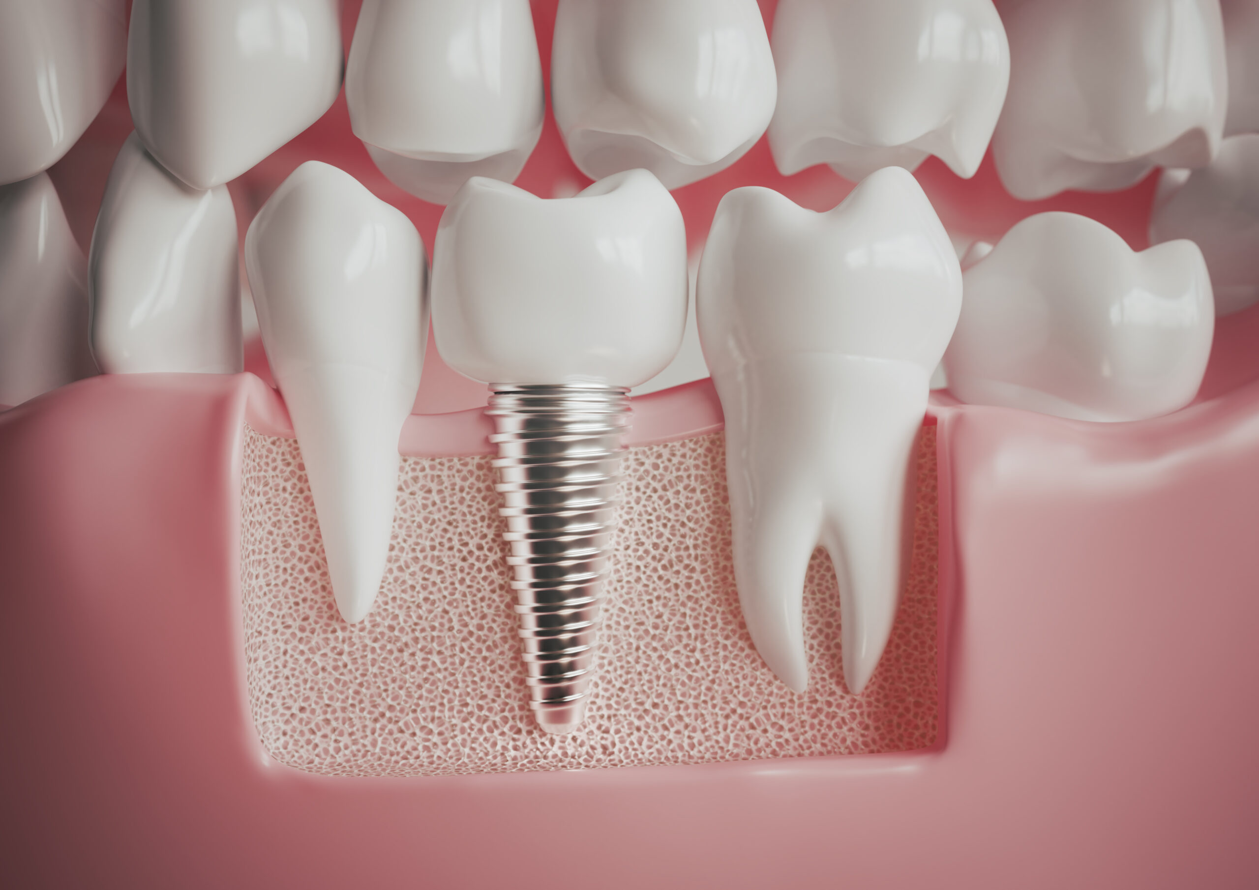 Implantation without surgery