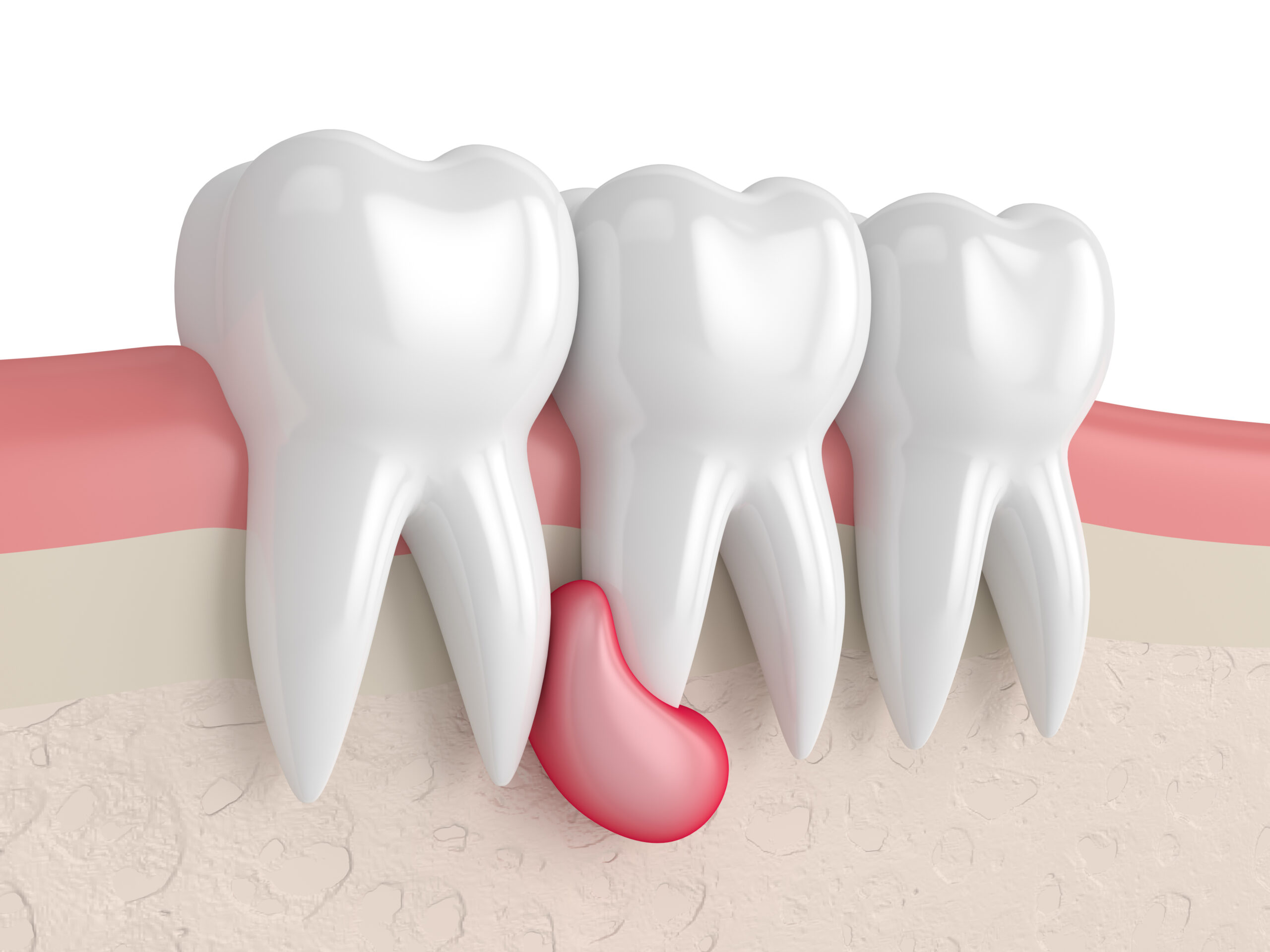 Removal of a dental cyst