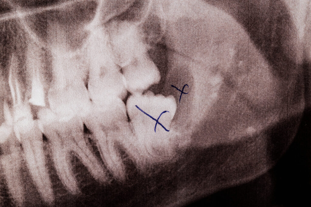 Removal of a dental cyst